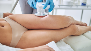 Liposuction Under Local Anesthesia in New York, New York